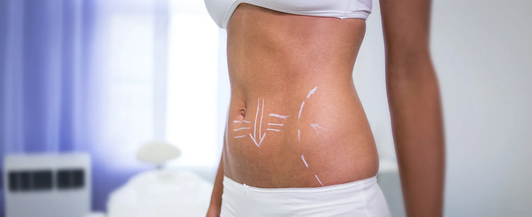 Tummy Tuck