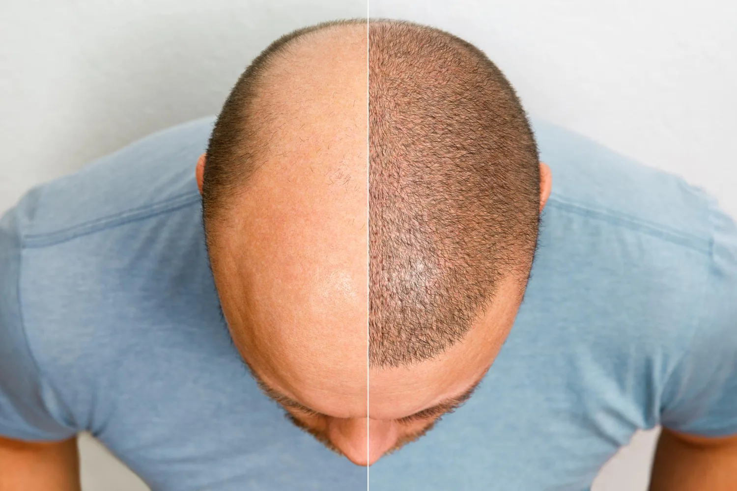 Turkey or Cyprus: Which Is Right for Your Hair Transplant?