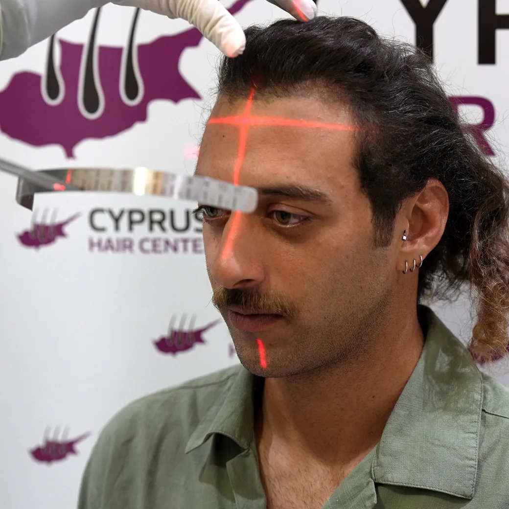 Surgeon marking the hairline with a laser level on operation day at Cyprus Hair Center