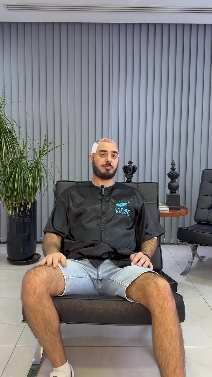 Patient story video: hair transplant at Cyprus Hair Center