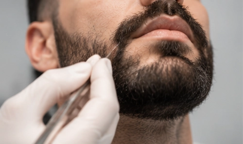 Beard Transplant