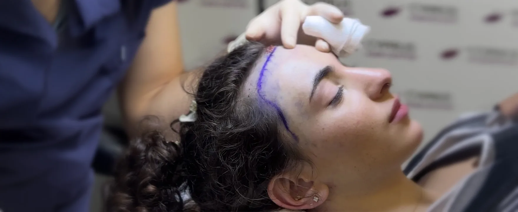 Hair Transplant for Women