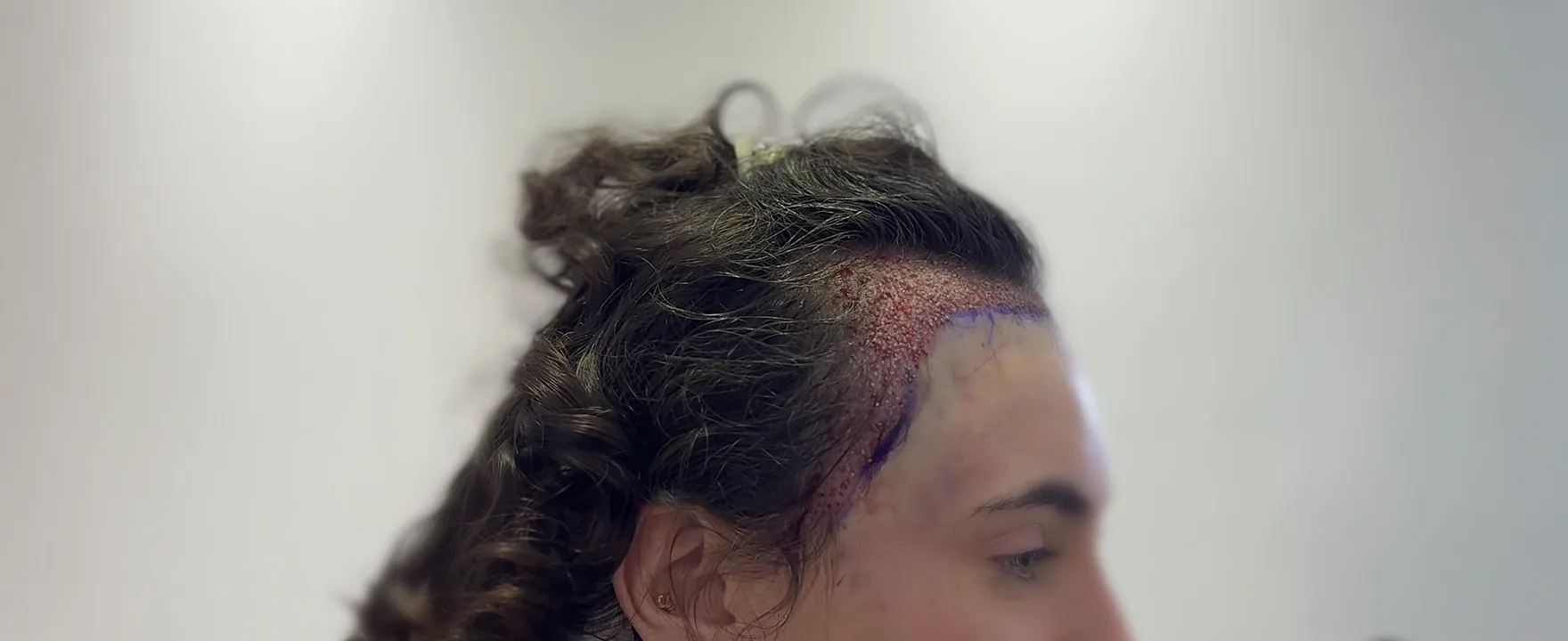 Grafts harvested with the hair shaft left long during a long hair transplant