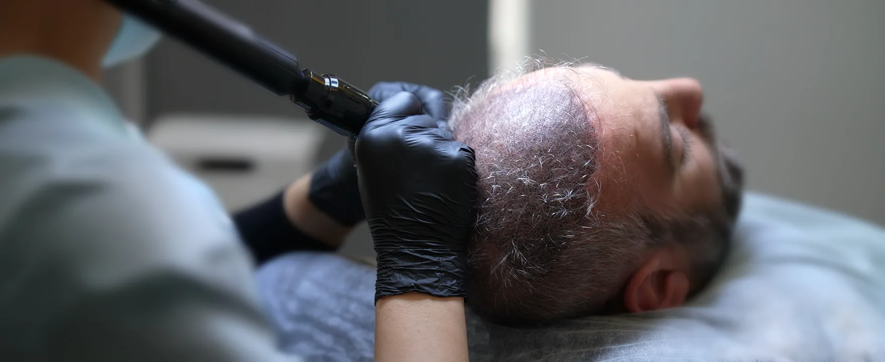 Micro follicle impressions being applied to the scalp during scalp micropigmentation
