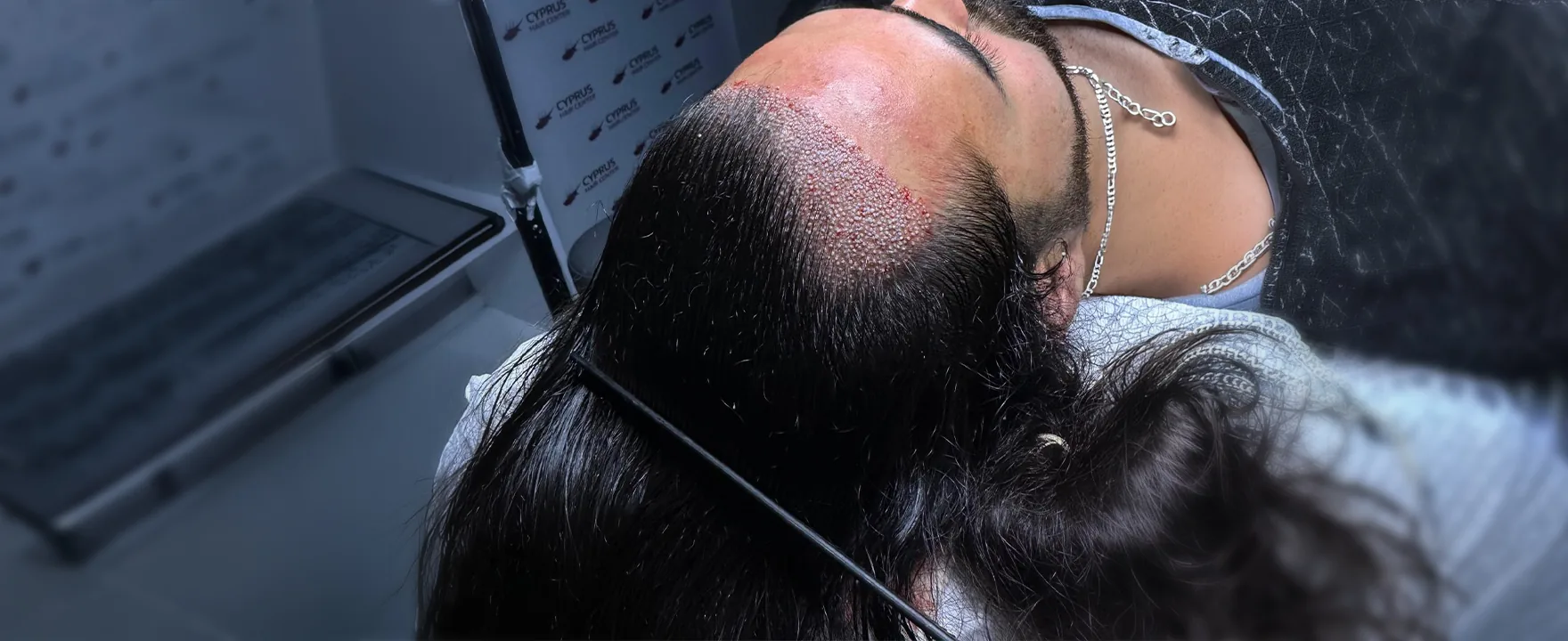 Unshaven Hair Transplant