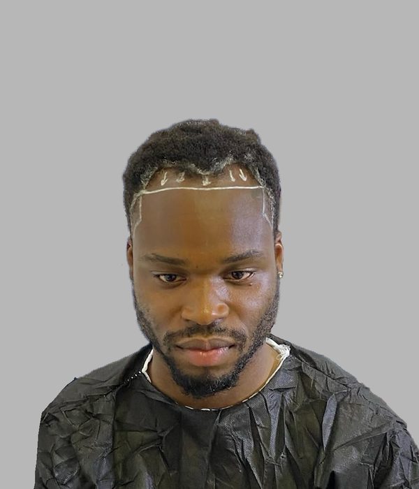 Hair transplant result, before