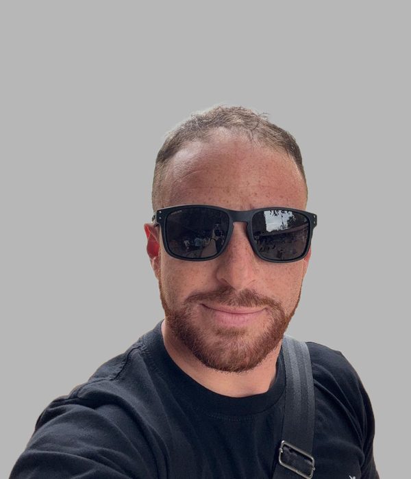 Hair transplant result, before