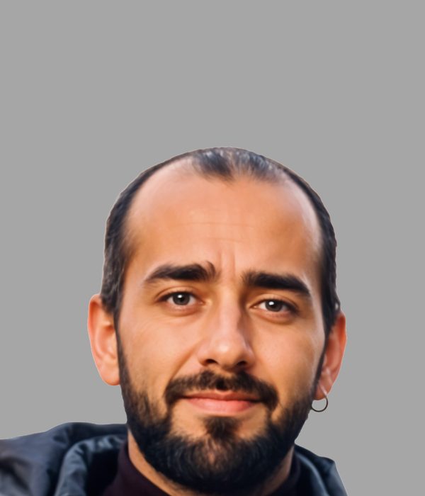 Hair transplant result, before