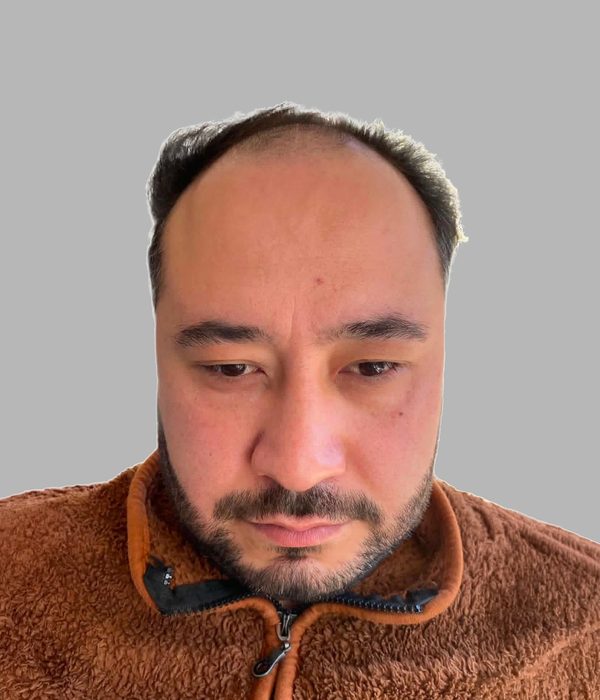Hair transplant result, before