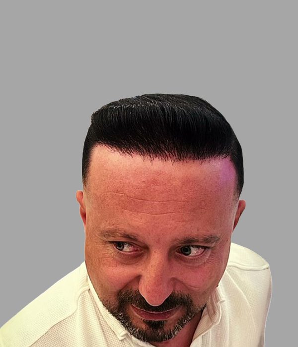 Hair transplant result, after