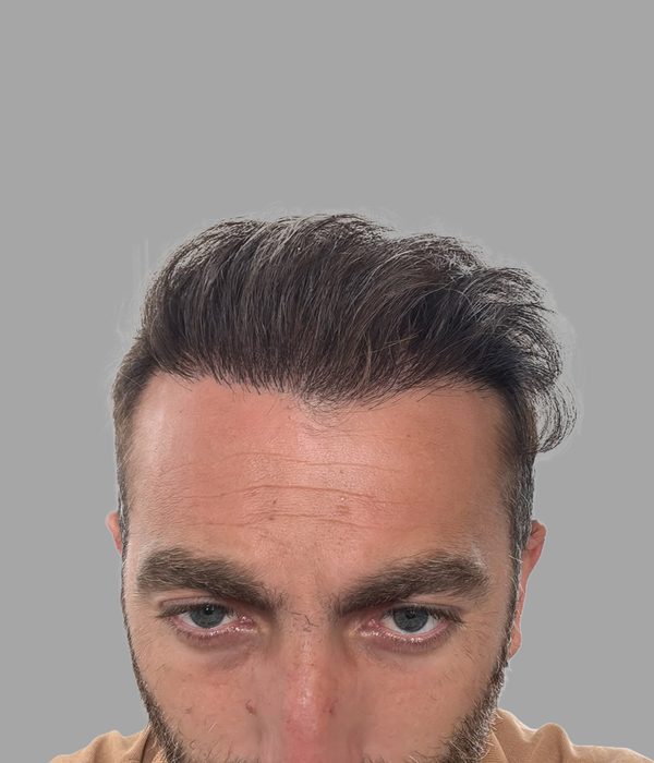 Hair transplant result, after