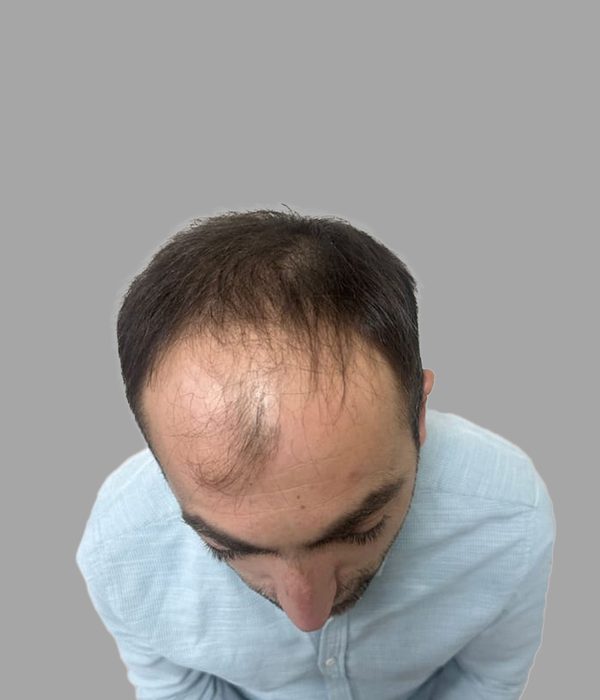Hair transplant result, before