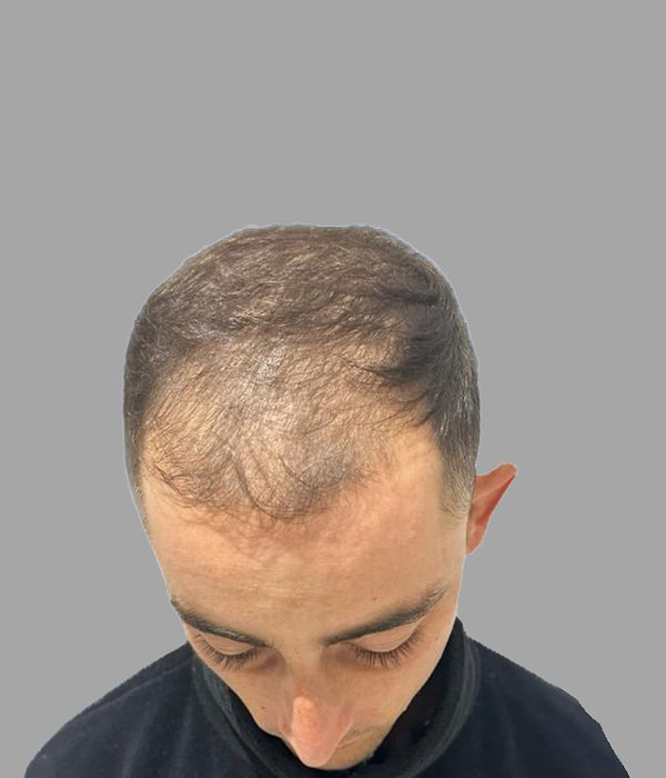Hair transplant result, before