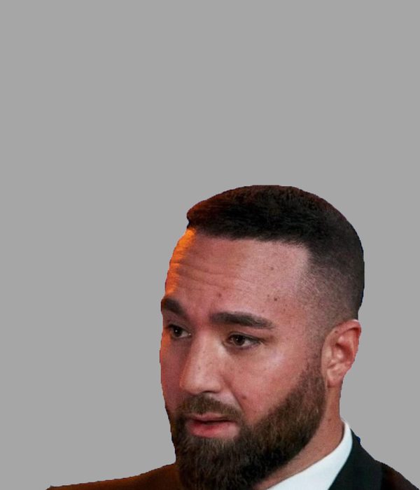 Hair transplant result, after