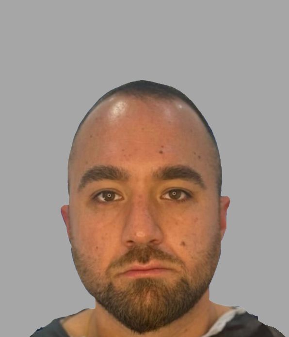 Hair transplant result, before