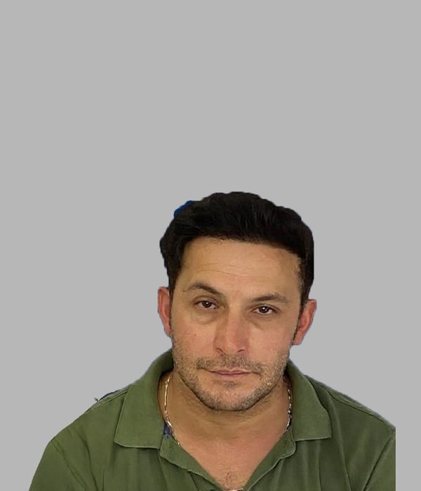 Hair transplant result, after