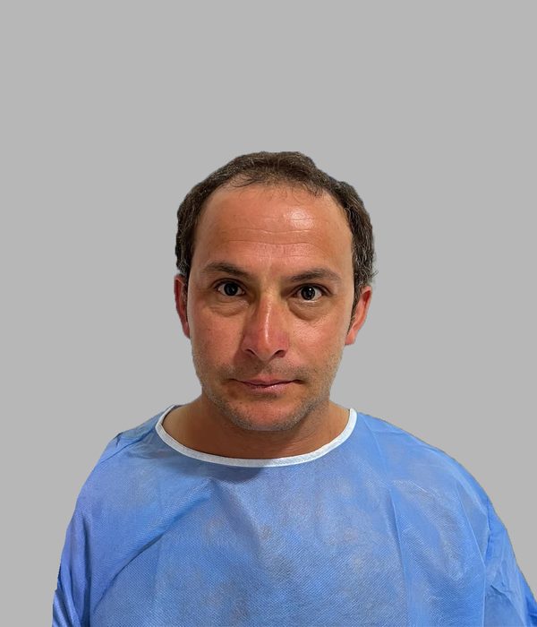 Hair transplant result, before