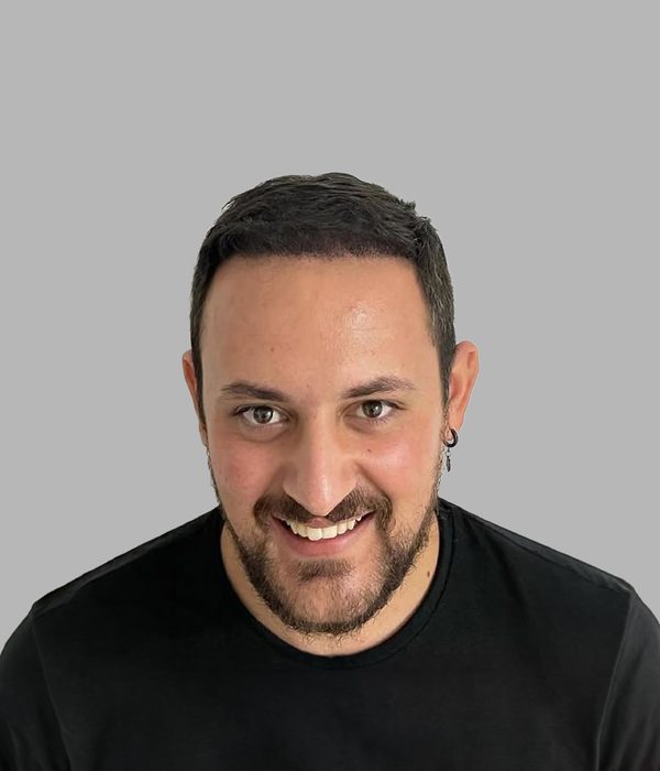 Hair transplant result, after