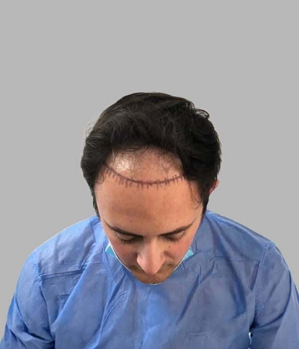 Hair transplant result, before