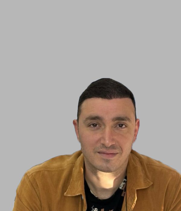 Hair transplant result, after