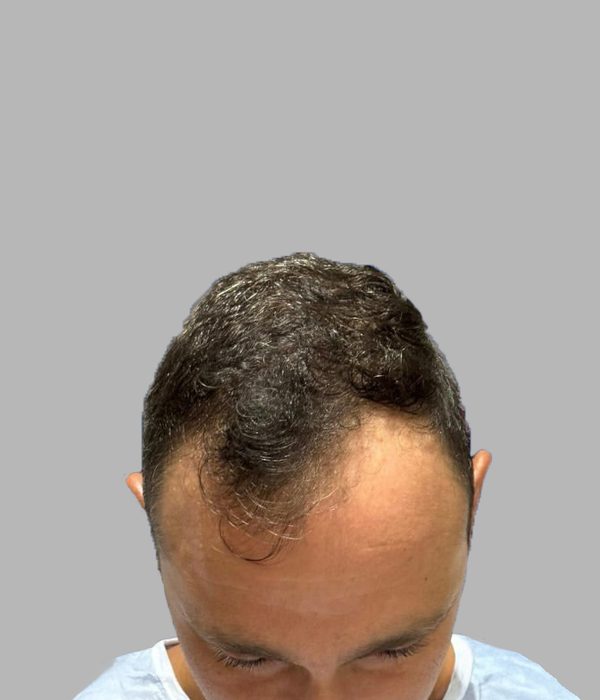 Hair transplant result, before