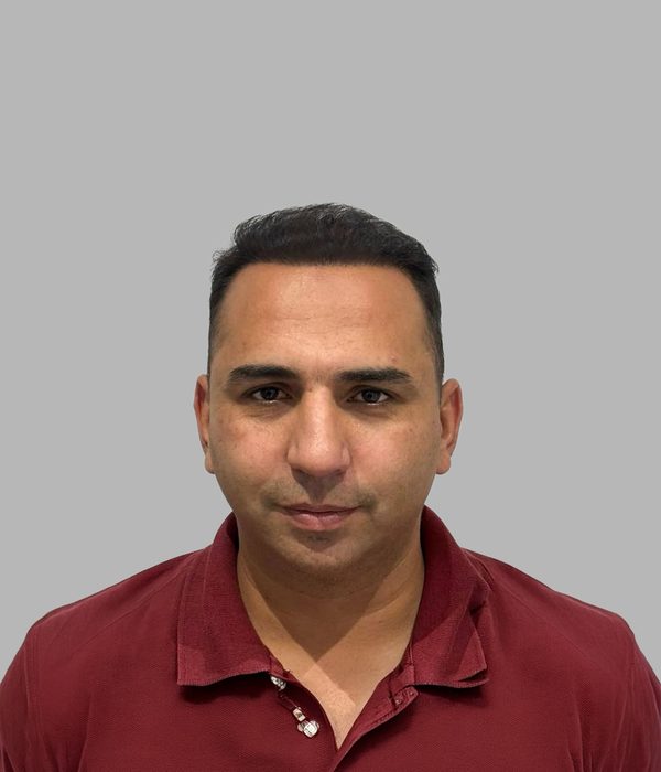 Hair transplant result, after