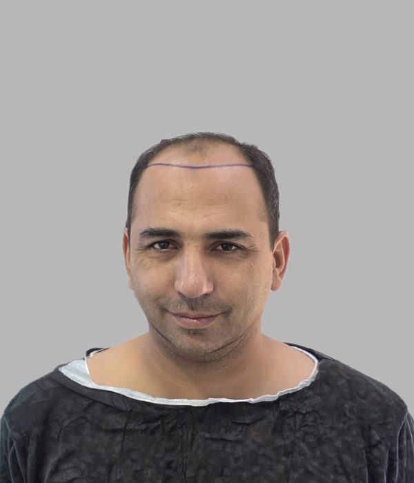 Hair transplant result, before