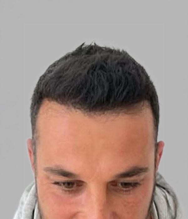 Hair transplant result, after