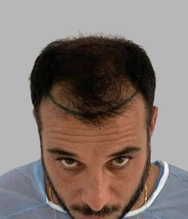 Hair transplant result, before