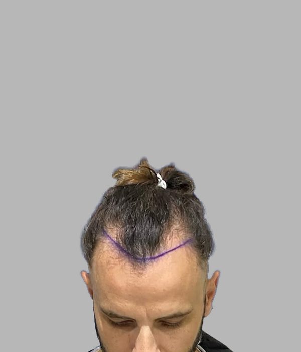 Hair transplant result, before