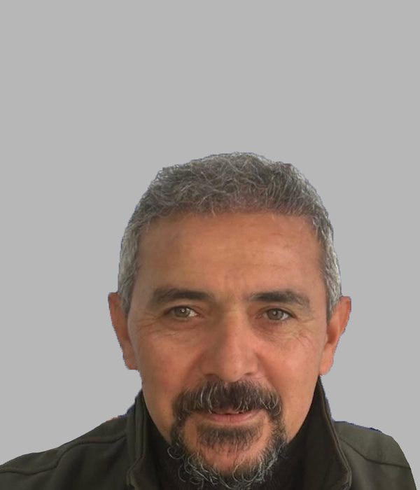 Hair transplant result, after