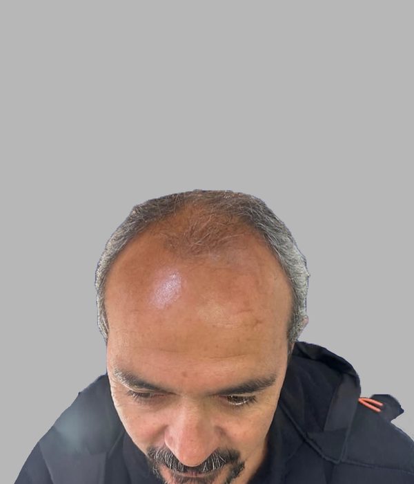 Hair transplant result, before