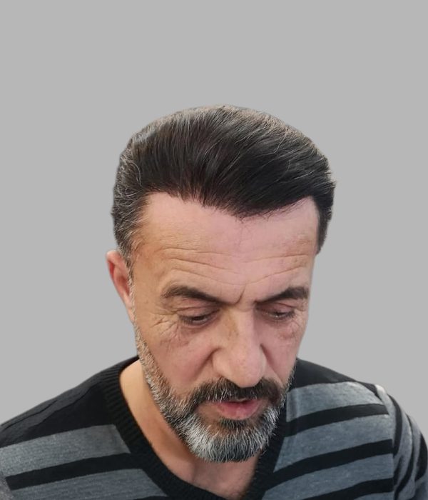 Hair transplant result, after