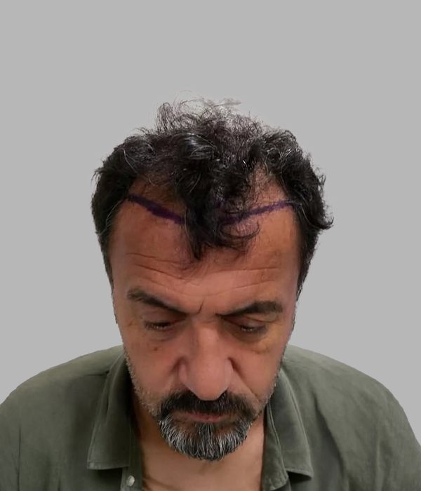 Hair transplant result, before