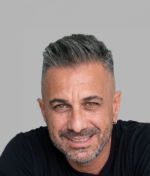 Hair transplant result, after