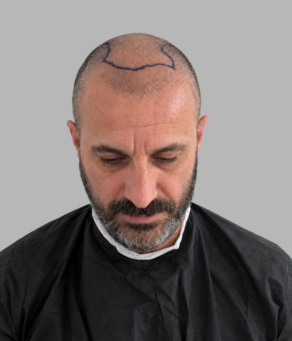 Hair transplant result, before